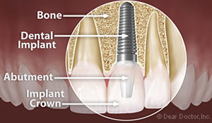 Dental Implants Kinnelon NJ