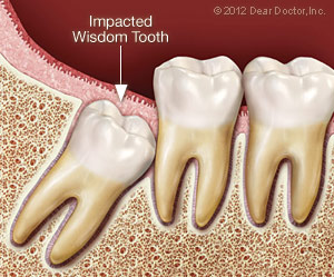 Impacted wisdom tooth needing extraction, Kinnelon, NJ
