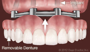 Kinnelon Dental Implants Support Removable Dentures.