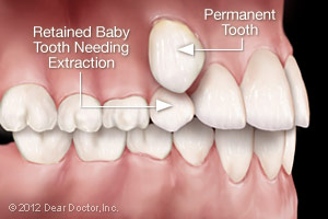 Retained baby tooth needing extraction Kinnelon, NJ